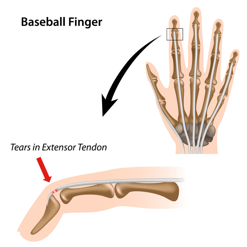 Mallet Finger Hand Injury Causes Symptoms Treatments