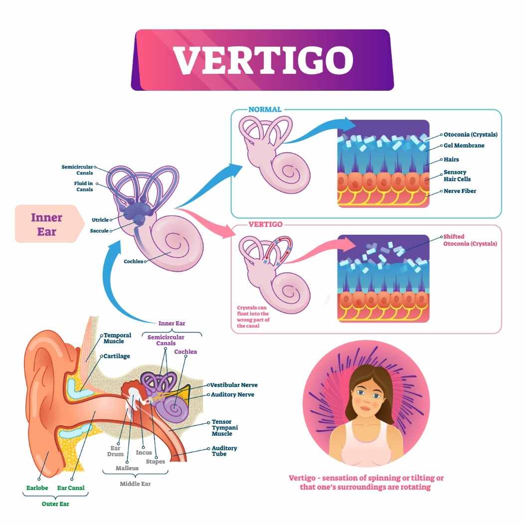 46+ schön Bilder Dizziness Caused By Crystals In Inner Ear / Vertigo